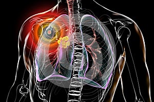 Primary lung tuberculosis, 3D illustration photo