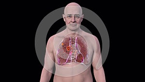 Primary lung tuberculosis in a man with the Ghon complex, 3D animation
