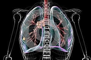 Primary lung tuberculosis with the Ranke complex, 3D illustration photo