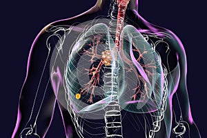Primary lung tuberculosis with the Ranke complex, 3D illustration photo