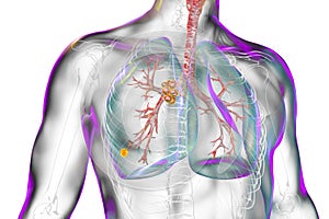 Primary lung tuberculosis with Ranke complex, illustration