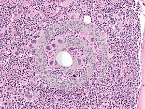 Primary myelofibrosis in bone marrow.