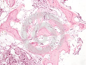 Primary myelofibrosis in bone marrow.