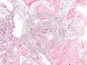 Primary myelofibrosis in bone marrow. photo
