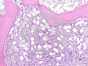 Primary myelofibrosis in bone marrow. photo