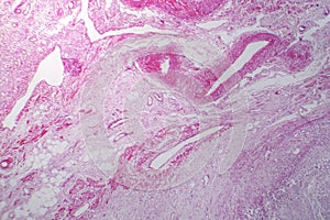 Primary particulate contracted kidney, light micrograph