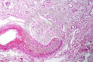 Primary particulate contracted kidney, light micrograph