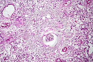 Primary particulate contracted kidney, light micrograph