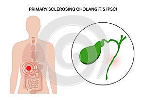 Primary sclerosing cholangitis photo