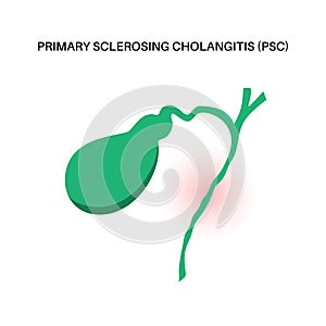 Primary sclerosing cholangitis photo