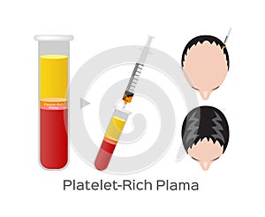 Platelet-Rich plasma procedure stages / prp / Centrifuge  / cure Baldness / hair concept photo