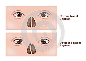 Deviated nasal septum  / human nose