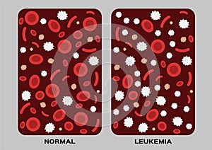 Leukaemia / human blood concept / white and red blood cell
