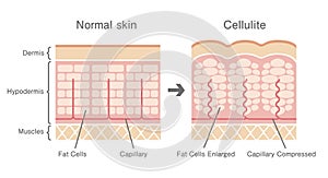 Comparative illustration of normal skin and cellulite`s skin