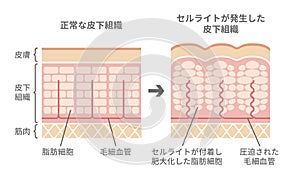 Comparative illustration of normal skin and cellulite`s skin