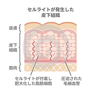 Cellulite`s skin vector illustration
