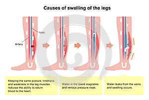 Cause of swelling, edema of the legs. / english