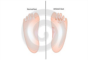 Athlete's foot