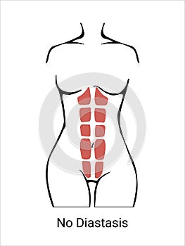 No Diastasis