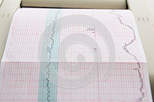 Printing of cardiogram report coming out from Electrocardiograph in labour ward