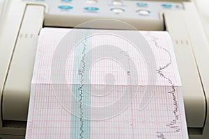 Printing of cardiogram report coming out from Electrocardiograph in labour ward