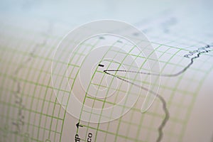 Printing of cardiogram report coming out from Electrocardiograph in labour ward