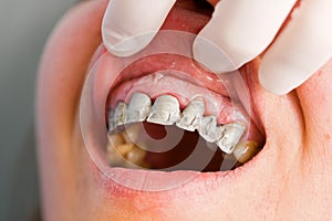 Probation of a fixed partial denture