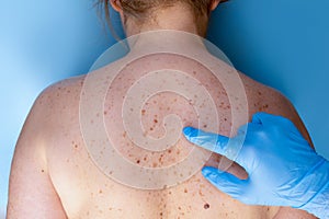 Problem skin with birthmarks. Dermatologist examining the patient. Closeup of freckles on the back of a woman