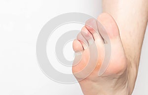 Problem skin with calluses and corns on the sole of the human foot, dry and rough skin, inflammation and pain, foot, close-up