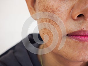 Problem skincare and health concept. wrinkles, melasma, dark spots, freckles, dry skin on face middle age women. photo