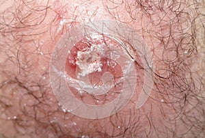 Problematic skin and acne red