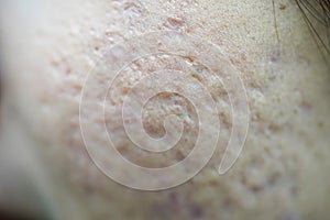 Problematic skin with deep acne scars on cheek