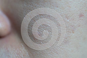 Problematic skin with deep acne scars on cheek