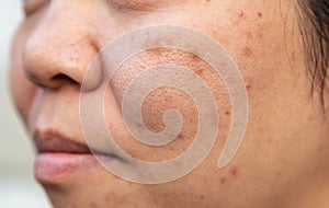 Problems facial skin is acne and blemishes photo