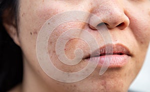 Problems facial skin is acne and blemishes photo