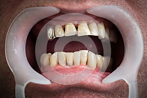 Problems with the teeth and gums concept. One of the health problems in the elderly.