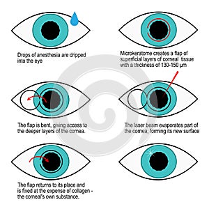 Procedure of laser correction of vision step by step. Infographics photo