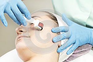 Procedure of medical micro needle therapy with a modern medical instrument derma roller