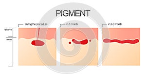 The process of engraftment of the pigment after the salon procedure of permanent make-up.