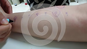 Process of food allergy skin prick test with rash sensitive reaction