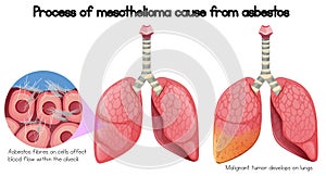 Process of mesothelioma cause of asbestos photo