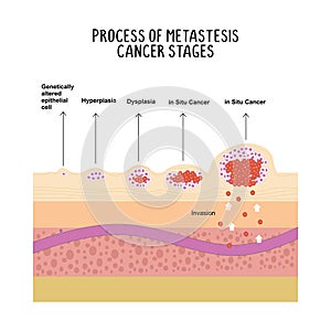 process of metastases cancer stages illustration isolated on white background