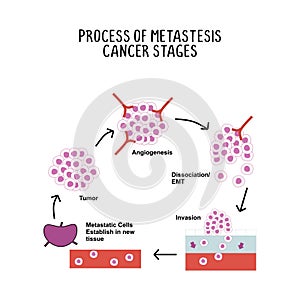 process of metastases cancer stages illustration isolated on white background photo