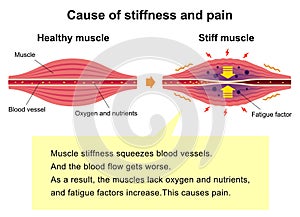 Process of muscle`s stiffness and pain / English