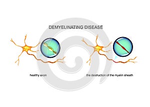 Process of nerve fiber destruction