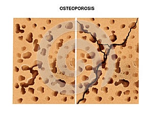 Process of osteoporosis
