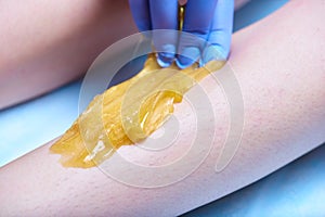 A process of sugaring depilation