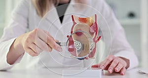 Proctologist with a magnifying glass in his hand showing rectum pathologies on an anatomical model