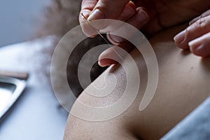 Profesional woman giving acupuncture treatment