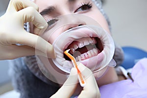 Professional cleaning of the space between the teeth. A young girl at a dentist`s appointment looks at herself in the